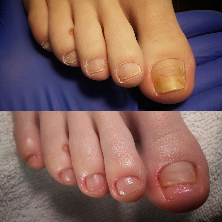 Before and after applying Yesenia's Exodermin cream
