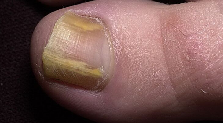 damage to the toenail with a fungal infection