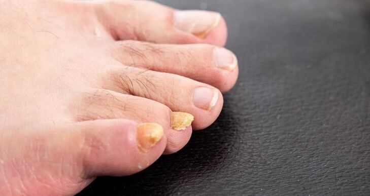 yellowing of the nails with nribka on the feet