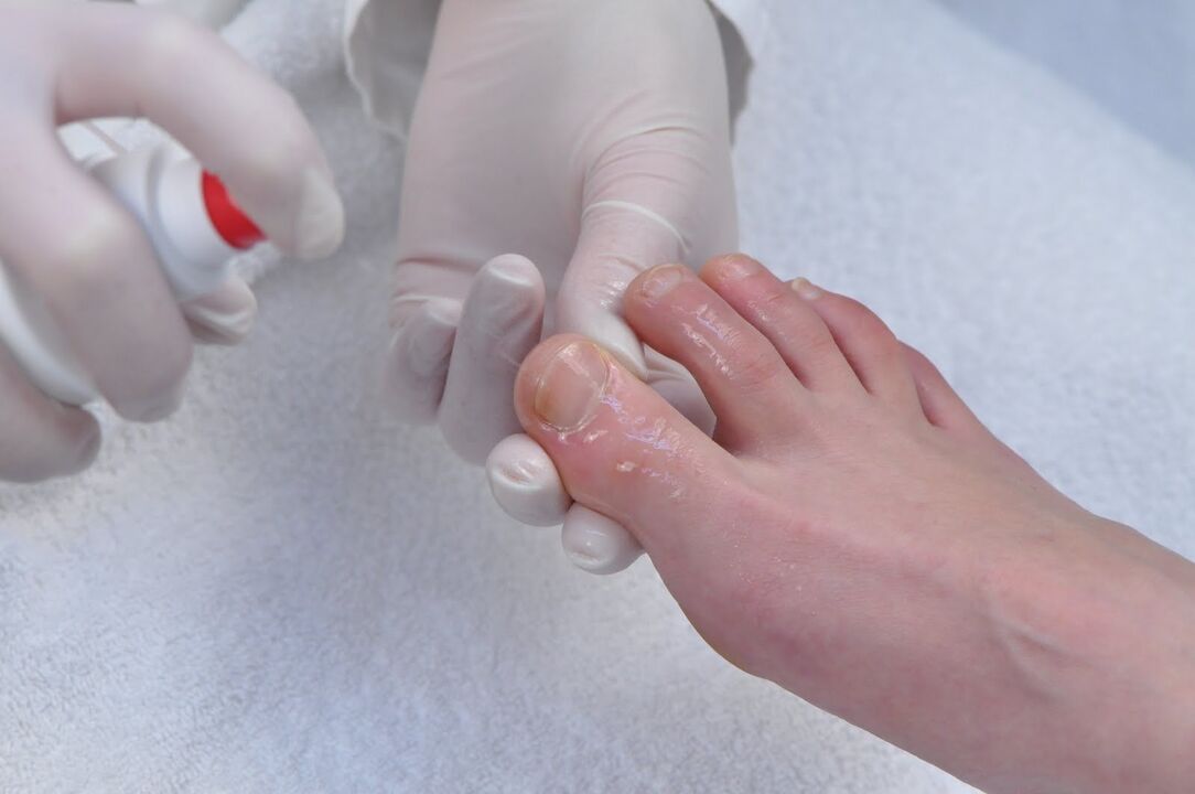 toenail fungus treatment