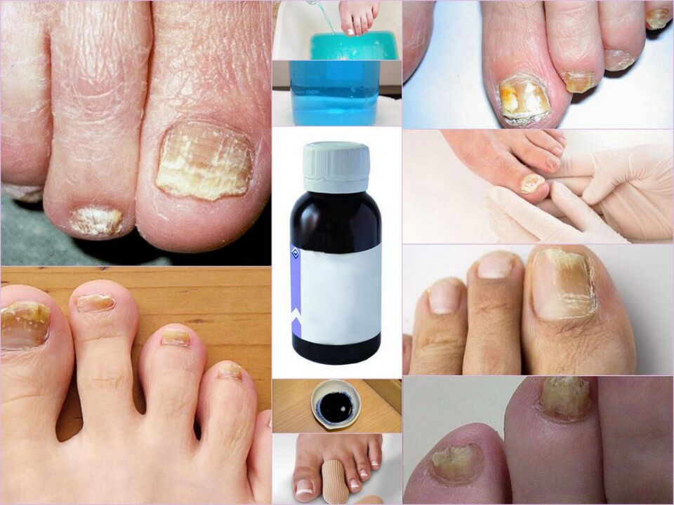 medicines against toenail fungus