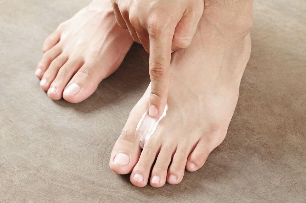 Application of a special ointment to treat the interdigital form of the foot fungus. 