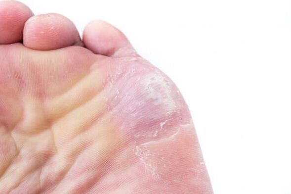 Manifestations of rubrophytosis on the skin of the foot. 