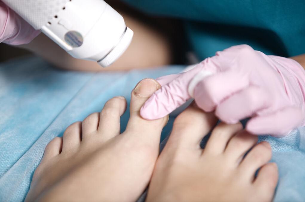 Medical pedicure in a podiatrist for onychomycosis