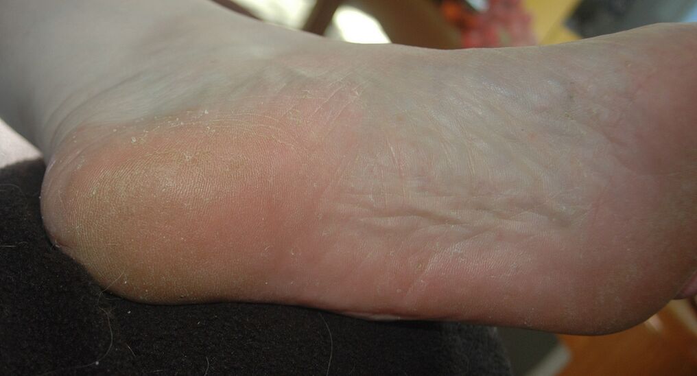 Squamous-hyperkeratotic form of foot fungus