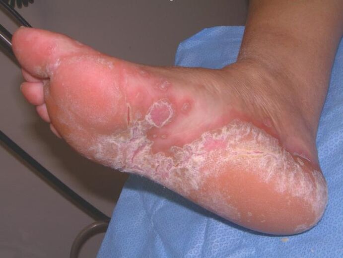 A foot affected by a fungal infection