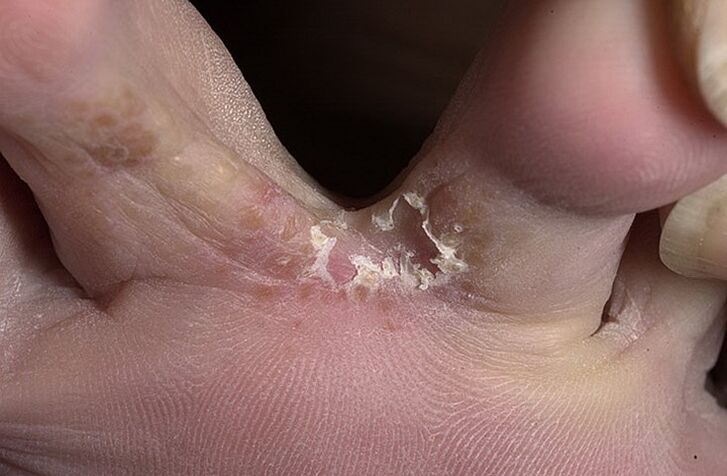 Cracked skin between the toes is a symptom of an intertriginous fungus