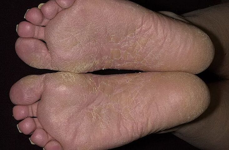Dry, flaky skin on the feet is a sign of squamous mycosis. 