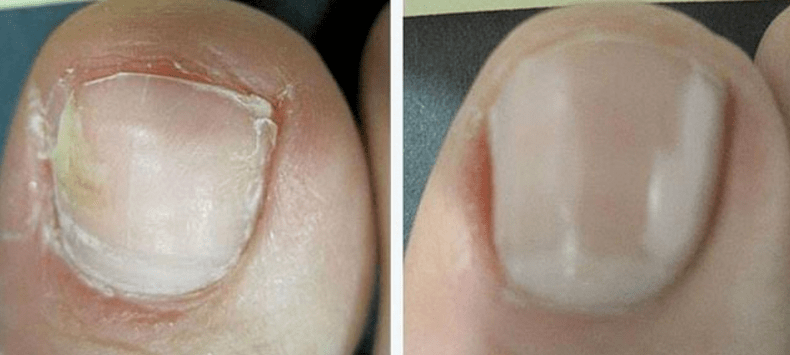 Toenail before and after fungus treatment. 