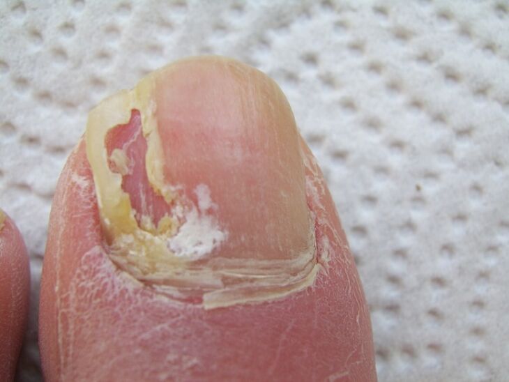 With onychomycosis, a deformation of the nail plate occurs. 
