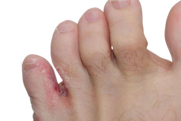symptoms of fungus between the toes
