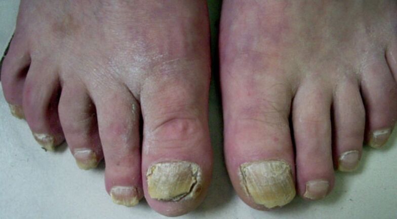 careless toenail fungus