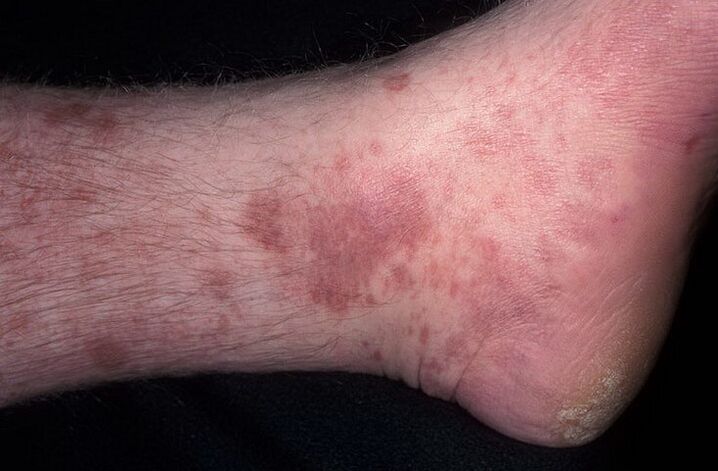 fungal eczema on the leg