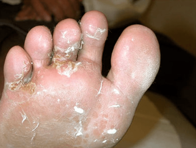 the development of toe fungus
