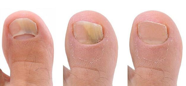 toenail fungus stages