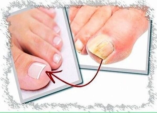 Before and after toenail fungus treatment. 