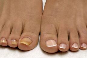 feet before and after nail fungus treatment