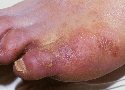 An example of a fungal foot infection caused by Trichophyton interdigitale