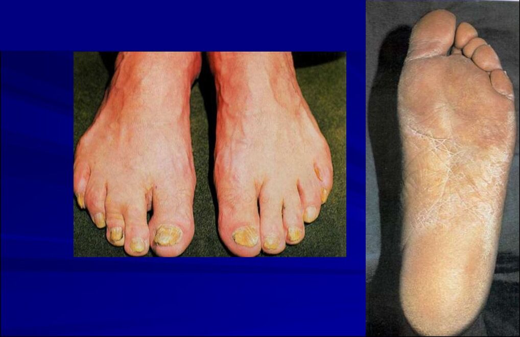 Squamous-hyperkeratotic form of the fungus (rubromycosis of the foot)