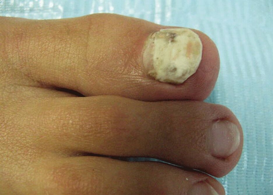 damage to the nails from the plate with fungus