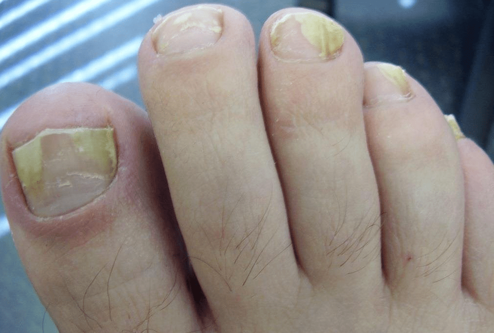 yellow nails due to a fungal infection