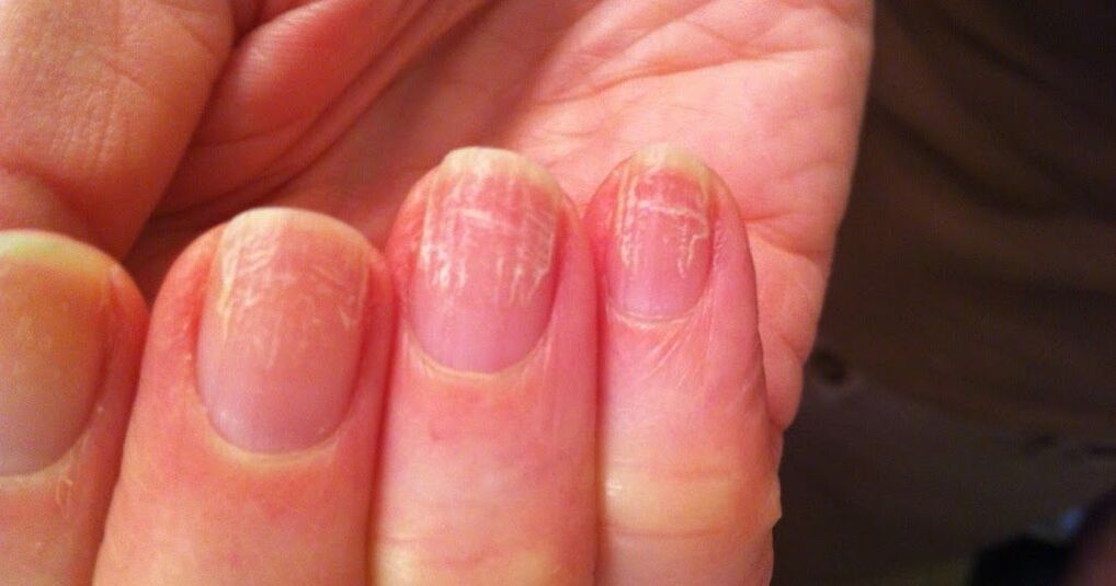 What does nail fungus look like