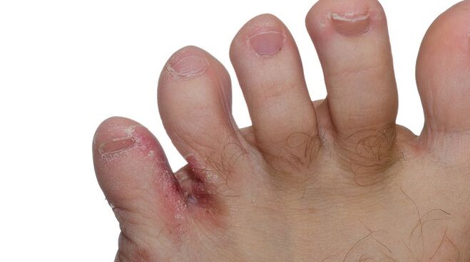 Signs of fungus between the toes cracks and peeling skin