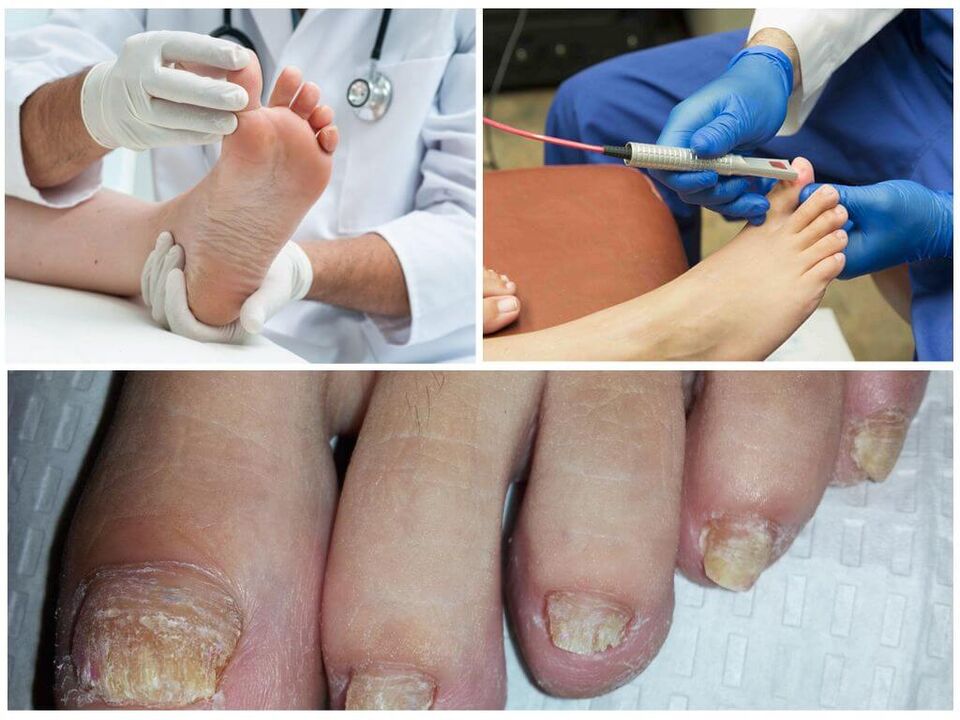 A doctor diagnoses and treats toenails affected by a fungal infection. 