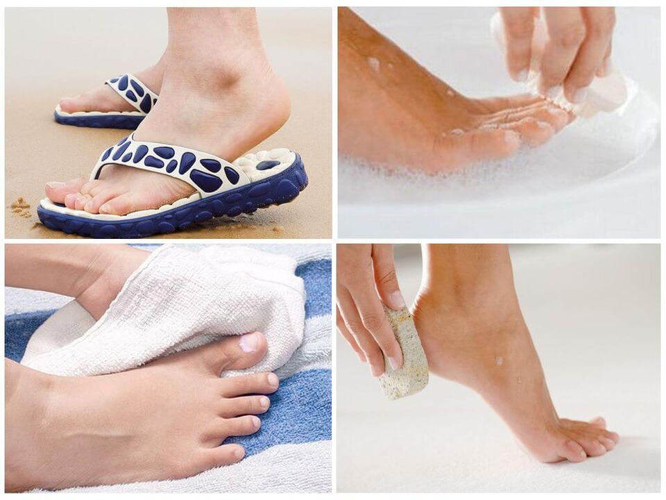 Prevention of onychomycosis includes foot hygiene, the use of personal items and timely pedicures. 