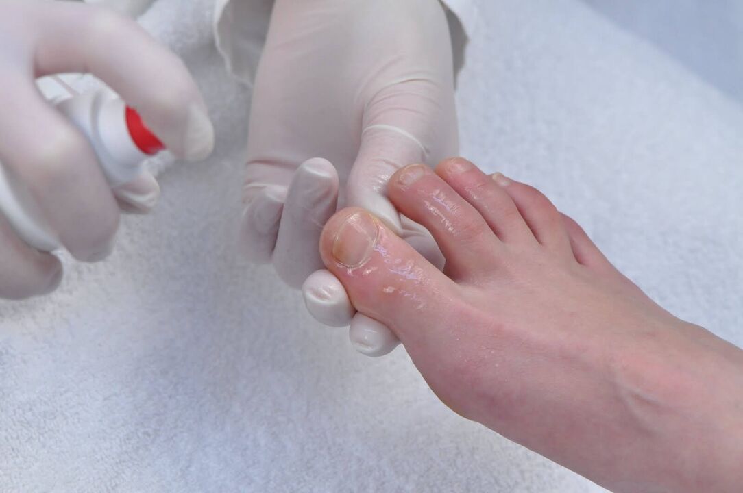The initial stage of onychomycosis is a reason to undergo a diagnostic examination by a dermatologist. 