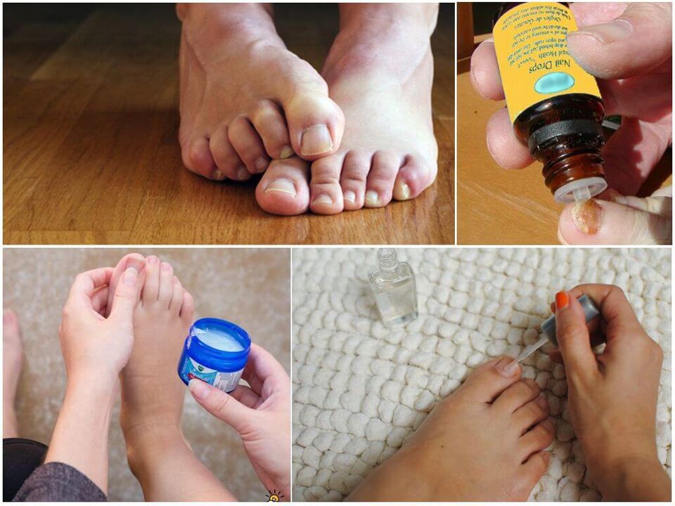 Treatment of toenail fungus with antifungal solutions, ointments and varnishes. 