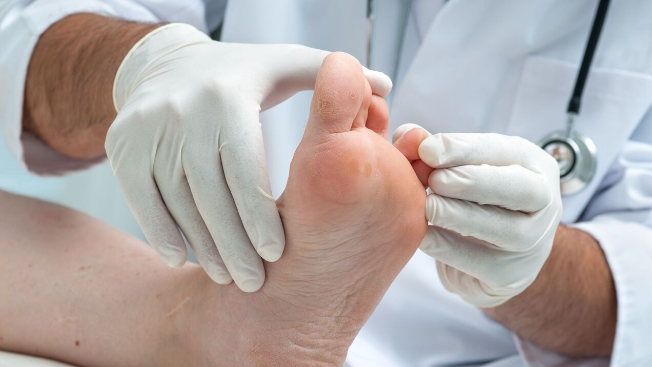 Diagnosis of foot fungus. 