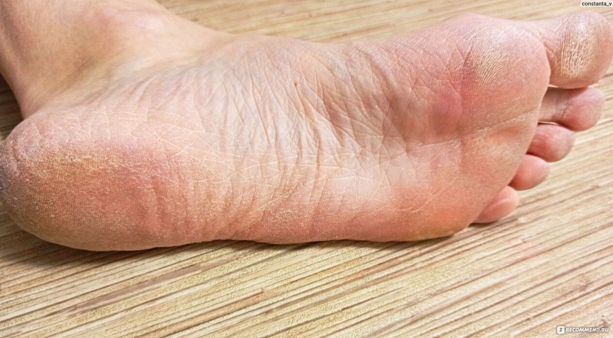 fungus on human foot